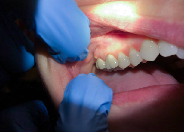 Best Emergency Broken Tooth Repair in Attleboro, MA